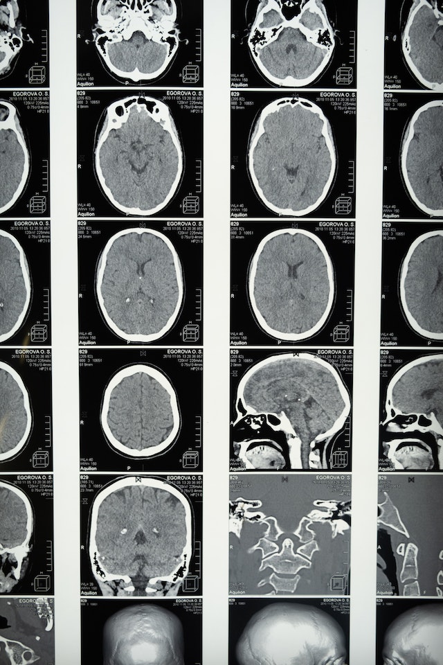 The plural of cortex is cortices or cortexes